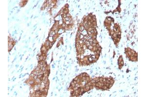 Formalin-fixed, paraffin-embedded human Breast Carcinoma stained with PDZ and LIM Domain 1 Mouse Monoclonal Antibody (PDLIM-1). (PDLIM1 anticorps)