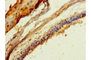 Immunohistochemistry of paraffin-embedded human breast cancer using ABIN7148239 at dilution of 1:100