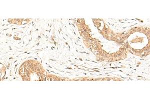 Immunohistochemistry of paraffin-embedded Human breast cancer tissue using FBXL4 Polyclonal Antibody at dilution of 1:25(x200) (FBXL4 anticorps)