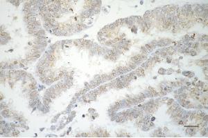 Immunohistochemistry was performed on paraffin-embedded human ovarian carcinoma using RAD51 recombinase antibody (ABIN7798367), 1:200). (Recombinant RAD51 anticorps)