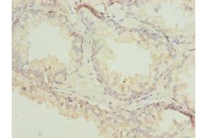 Immunohistochemistry of paraffin-embedded human prostate cancer using ABIN7143059 at dilution of 1:100 (Actl7b anticorps  (AA 1-415))