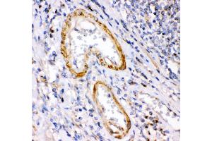 Anti- Calretinin Picoband antibody, IHC(P) IHC(P): Human Intestinal Cancer Tissue