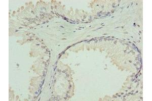 Immunohistochemistry of paraffin-embedded human prostate cancer using ABIN7154735 at dilution of 1:100 (GNa14 anticorps  (AA 8-303))