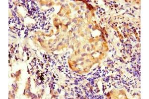 Immunohistochemistry of paraffin-embedded human lung cancer using ABIN7161015 at dilution of 1:100 (NOXA1 anticorps  (AA 150-313))