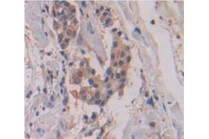 IHC-P analysis of Human Tissue, with DAB staining. (MMP13 anticorps  (AA 290-468))