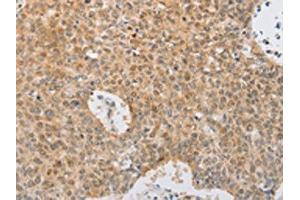 The image on the left is immunohistochemistry of paraffin-embedded Human lung cancer tissue using ABIN7131039(SERPINE2 Antibody) at dilution 1/20, on the right is treated with fusion protein.