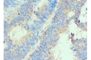 Immunohistochemistry of paraffin-embedded human colon cancer using ABIN7155937 at dilution of 1:100
