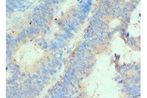 Immunohistochemistry of paraffin-embedded human colon cancer using ABIN7155937 at dilution of 1:100 (HIP1 anticorps  (AA 410-690))