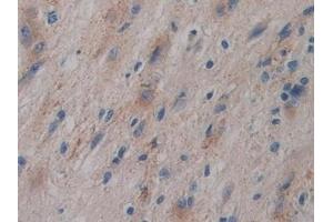 Detection of GPLD1 in Human Glioma Tissue using Polyclonal Antibody to Glycosylphosphatidylinositol Specific Phospholipase D1 (GPLD1) (GPLD1 anticorps  (AA 496-840))