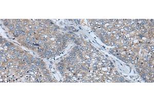 Immunohistochemistry of paraffin-embedded Human liver cancer tissue using BICD2 Polyclonal Antibody at dilution of 1:70(x200) (BICD2 anticorps)