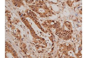ABIN6267627 at 1/50 staining human colon cancer tissue sections by IHC-P. (FOXO1 anticorps  (pSer319))