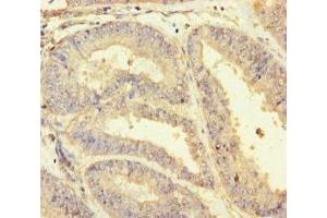 Immunohistochemistry of paraffin-embedded human endometrial cancer using ABIN7154855 at dilution of 1:100 (HSPA12B anticorps  (AA 201-500))