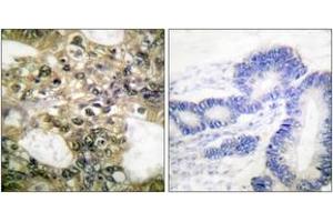 Immunohistochemistry analysis of paraffin-embedded human colon carcinoma tissue, using HDAC6 Antibody. (HDAC6 anticorps  (AA 1166-1215))