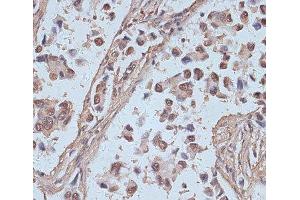 Immunohistochemistry of paraffin-embedded Human lung cancer using SNW1 Polyclonal Antibody at dilution of 1:100 (40x lens).