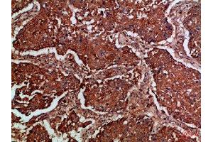 Immunohistochemical analysis of paraffin-embedded Human-lung-cancer, antibody was diluted at 1:100