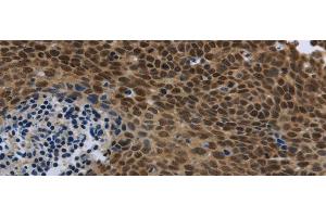 Immunohistochemistry of paraffin-embedded Human cervical cancer using SMAD4 Polyclonal Antibody at dilution of 1/40 (SMAD4 anticorps)