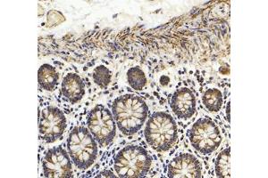 Immunohistochemistry of paraffin embedded human colon cancer using HSP60 (ABIN7074167) at dilution of 1: 1500 (200x lens)
