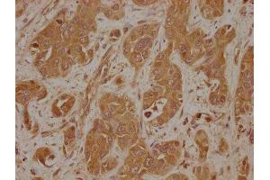 IHC image of ABIN7157890 diluted at 1:100 and staining in paraffin-embedded human liver cancer performed on a Leica BondTM system. (LAMb4 anticorps  (AA 1513-1761))