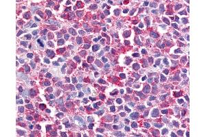 Anti-BEST2 / Bestrophin-2 antibody IHC of human Lymph Node, Non-Hodgkins Lymphoma. (Bestrophin 2 anticorps  (Internal Region))