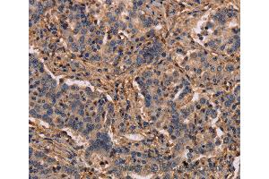 Immunohistochemistry of Human prostate cancer using MAP1LC3C Polyclonal Antibody at dilution of 1:40 (LC3C anticorps)