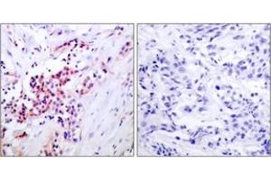 Immunohistochemistry analysis of paraffin-embedded human breast carcinoma, using NF-kappaB p65 (Phospho-Ser468) Antibody.