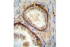 Immunohistochemistry analysis in formalin fixed and paraffin embedded human prostate carcinoma reacted with NUDT8 Antibody (N-term) followed by peroxidase conjugation of the secondary antibody and DAB staining. (NUDT8 anticorps  (N-Term))