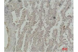 Immunohistochemistry (IHC) analysis of paraffin-embedded Human Lung Carcinoma using CREB-1 Monoclonal Antibody. (CREB1 anticorps)