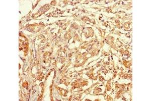 Immunohistochemistry of paraffin-embedded human pancreatic cancer using ABIN7171887 at dilution of 1:100 (Tetraspanin 7 anticorps  (AA 113-223))