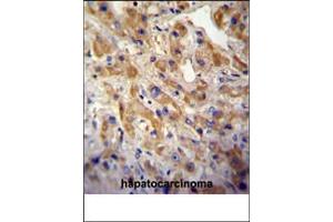 MET/HGFR Antibody (ABIN387742 and ABIN2838000) immunohistochemistry analysis in formalin fixed and paraffin embedded human hepatocarcinoma followed by peroxidase conjμgation of the secondary antibody and DAB staining. (c-MET anticorps  (Catalytic Domain))