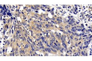 Detection of APAF1 in Human Lymphoma Tissue using Polyclonal Antibody to Apoptotic Peptidase Activating Factor 1 (APAF1)