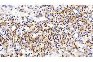 Detection of IL7R in Human Stomach cancer Tissue using Polyclonal Antibody to Interleukin 7 Receptor (IL7R) (IL7R anticorps  (AA 173-260))