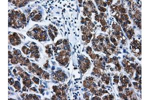 Immunohistochemical staining of paraffin-embedded Carcinoma of liver tissue using anti-BIRC7mouse monoclonal antibody. (BIRC7 anticorps)