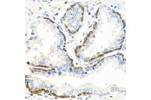 Immunohistochemistry of paraffin-embedded human prostate using BMP5 antibody. (BMP5 anticorps  (AA 317-454))