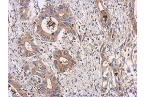 IHC-P Image Immunohistochemical analysis of paraffin-embedded human colon carcinoma, using ATIC, antibody at 1:100 dilution.