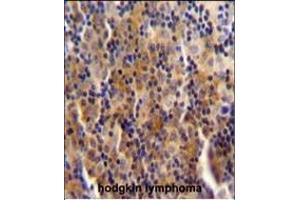 SYNE3 antibody (C-term) (ABIN654777 and ABIN2844458) immunohistochemistry analysis in formalin fixed and paraffin embedded human hodgkin lymphoma followed by peroxidase conjugation of the secondary antibody and DAB staining. (Nesprin3 anticorps  (C-Term))