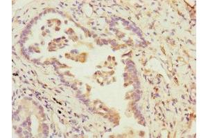 Immunohistochemistry of paraffin-embedded human lung cancer using ABIN7145189 at dilution of 1:100