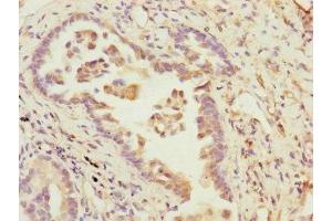 Immunohistochemistry of paraffin-embedded human lung cancer using ABIN7145189 at dilution of 1:100 (B9D2 anticorps  (AA 1-175))