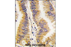 Formalin-fixed and paraffin-embedded human lung carcinoma tissue reacted with FRAT1 polyclonal antibody  , which was peroxidase-conjugated to the secondary antibody, followed by DAB staining. (FRAT1 anticorps  (C-Term))