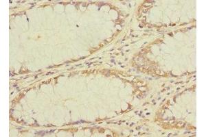 Immunohistochemistry of paraffin-embedded human colon cancer using ABIN7173139 at dilution of 1:100