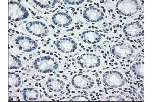 Immunohistochemical staining of paraffin-embedded colon tissue using anti-BRAFmouse monoclonal antibody. (BRAF anticorps)