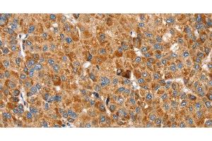 Immunohistochemistry of paraffin-embedded Human liver cancer using SSBP1 Polyclonal Antibody at dilution of 1:30 (SSBP1 anticorps)