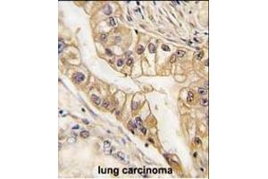 Formalin-fixed and paraffin-embedded human lung carcinoma tissue reacted with EPHB2 Monoclonal Antibody (ABIN387812 and ABIN2843903) , which was peroxidase-conjugated to the secondary antibody, followed by DAB staining.