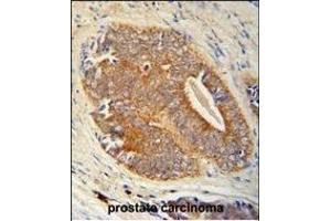 GAGE7 Antibody (C-term) (ABIN653712 and ABIN2843026) immunohistochemistry analysis in formalin fixed and paraffin embedded human prostate carcinoma followed by peroxidase conjugation of the secondary antibody and DAB staining.