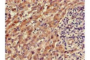 Immunohistochemistry of paraffin-embedded human liver cancer using ABIN7143656 at dilution of 1:100
