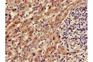 Immunohistochemistry of paraffin-embedded human liver cancer using ABIN7143656 at dilution of 1:100 (ADH5 anticorps  (AA 14-130))