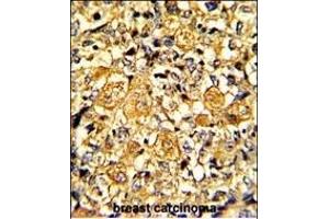 Formalin-fixed and paraffin-embedded human breast carcinoma with EGFR Monoclonal Antibody, which was peroxidase-conjugated to the secondary antibody, followed by DAB staining. (EGFR anticorps)