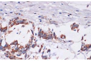 Immunohistochemistry of paraffin-embedded Human gastric cancer using DVL2 Polyclonal Antibody at dilution of 1:100 (40x lens). (DVL2 anticorps)