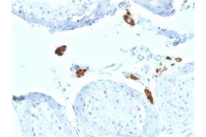 Formalin-fixed, paraffin-embedded human Testicular Carcinoma stained with Calretinin Mouse Monoclonal Antibody (CALB2/2602). (Calretinin anticorps  (AA 23-242))