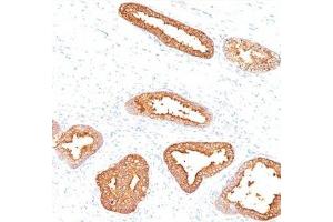 IHC testing of human prostate carcinoma stained with PSA antibody. (Prostate Specific Antigen anticorps)