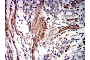 Immunohistochemical analysis of paraffin-embedded rectum cancer tissues using ACTA2 mouse mAb with DAB staining.